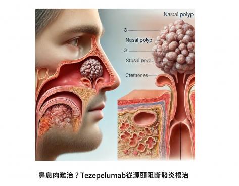 鼻息肉不再是「沒辦法的病」！新抗體藥物 Tezepelumab 從源頭阻斷發炎，98%不用手術