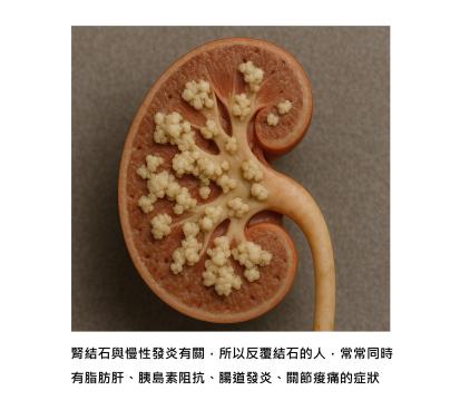 腎結石怎麼冒出來的 ? 活性氧與發炎失控是真正黑手