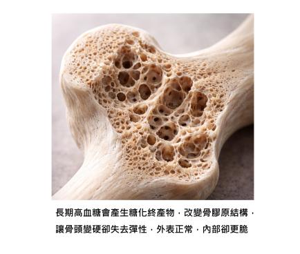 骨密度正常,為什麼還是會骨折?骨頭變硬卻更脆,糖尿病族群常被忽略的風險